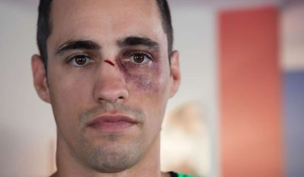 Durée d'un bleu au visage