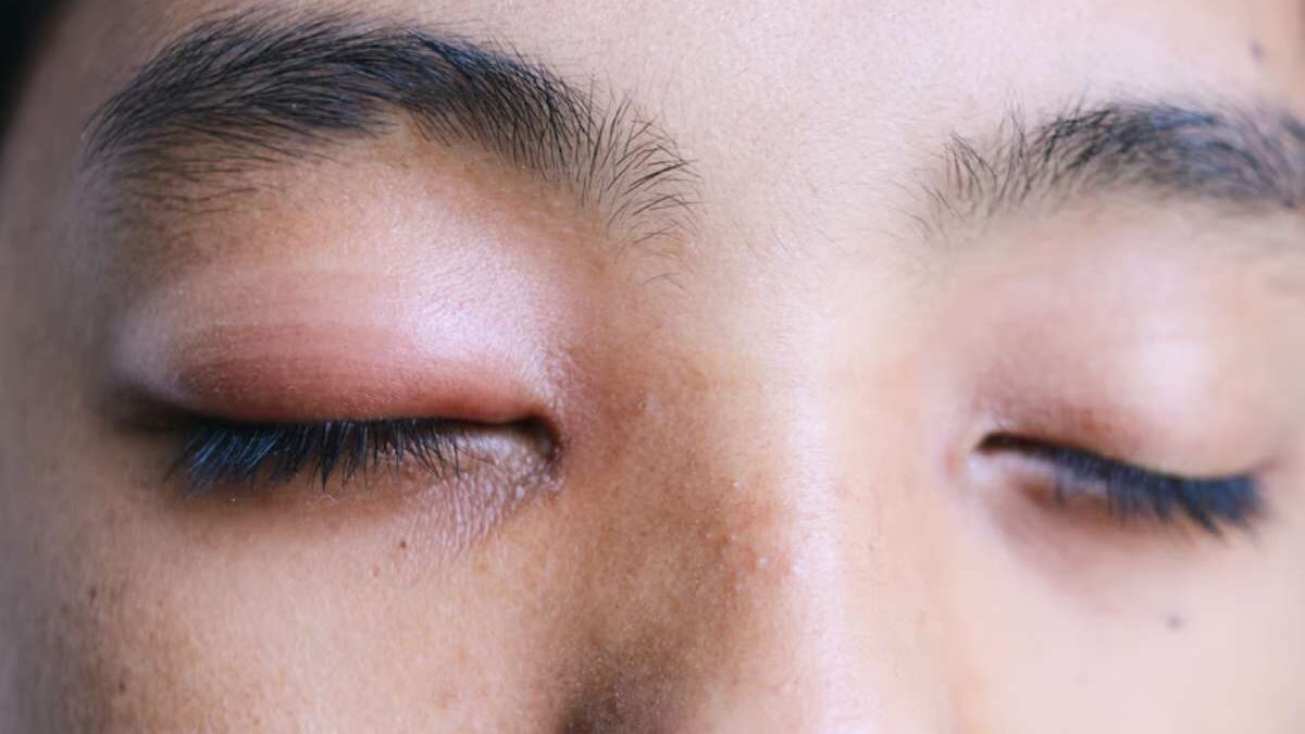 Allergie venin de guepe