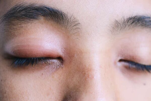 Allergie venin de guepe