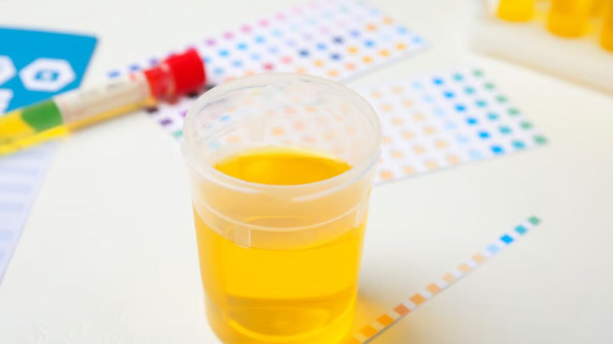 urine jaune fluo danger