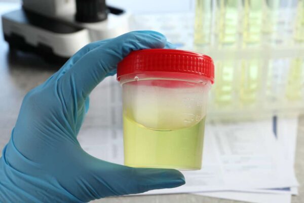 urine verte ou orange fluo